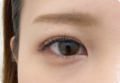 二重整形術「埋没法」：施術後1