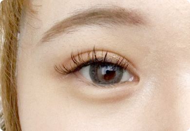 二重整形術「埋没法」：施術後2