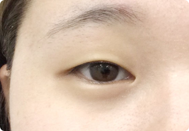 二重整形術「埋没法」：施術前2