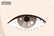 イラスト：全切開+デカ目形成術の施術前