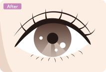 イラスト：全切開+デカ目形成術の施術後