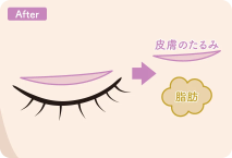 イラスト：全切開+デカ目形成術の施術後詳細