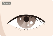 イラスト：全切開の施術前