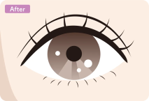 イラスト：全切開の施術後