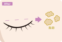 イラスト：全切開の施術後詳細