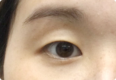 二重整形術「埋没法」：施術前1