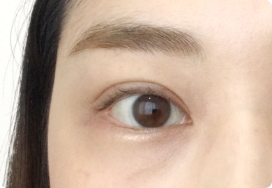 二重整形術「埋没法」：施術後2