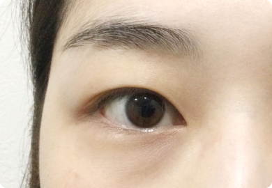 二重整形術「埋没法」：施術前2