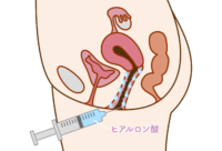 腟内ヒアルロン酸注射イメージ