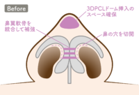 鼻尖形成：3DPCLドームBefore