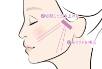 トミーリフト