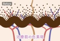 ピコレーザーBefore