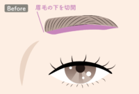 眉下切開Before