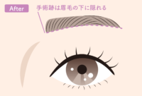 眉下切開After